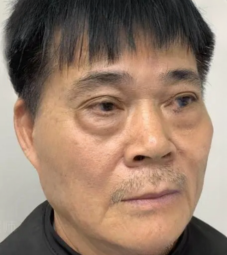 去眼袋手术