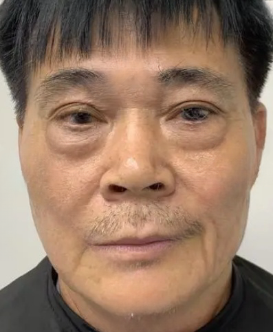 去眼袋手术
