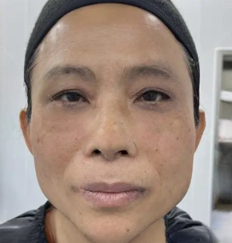 去眼袋手术
