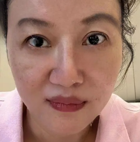 去眼袋手术