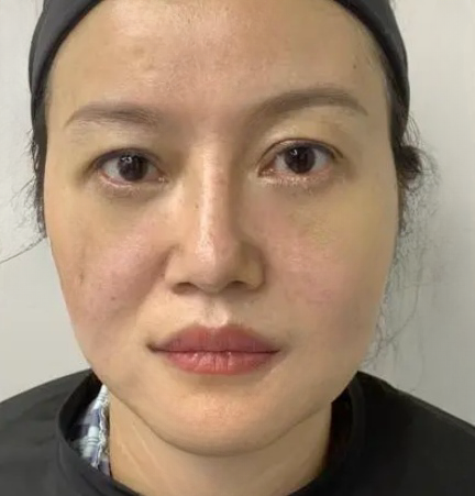 去眼袋手术