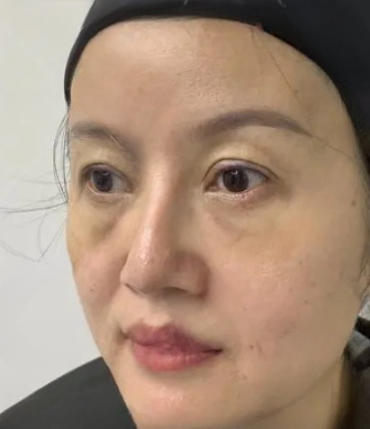 去眼袋手术