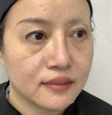 去眼袋手术