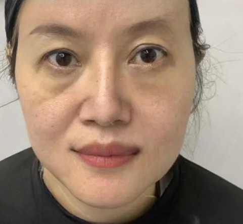 去眼袋手术