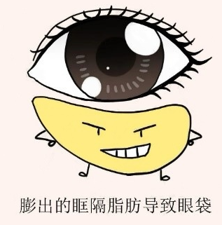 去眼袋手术