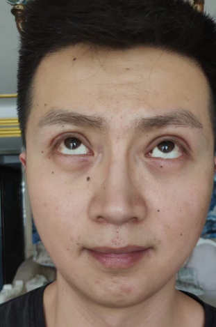 去眼袋手术