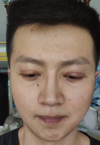 去眼袋手术