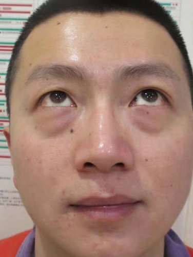 去眼袋手术