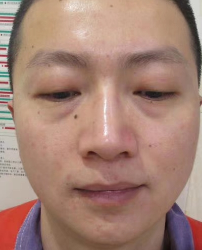 去眼袋手术