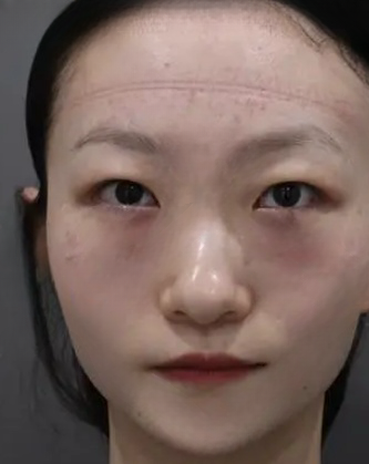 去眼袋手术