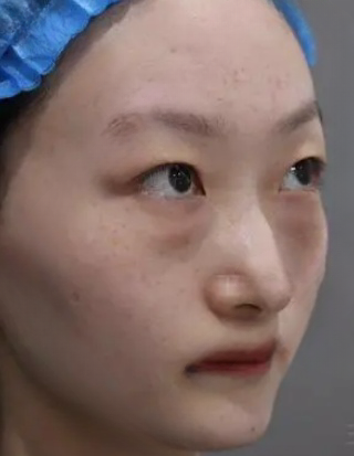 去眼袋手术