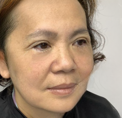 去眼袋手术