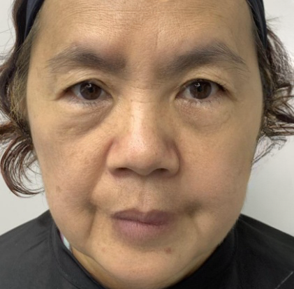 去眼袋手术