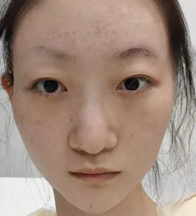 去眼袋手术