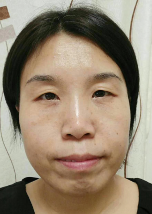 眼袋