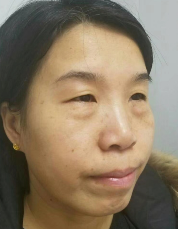 眼袋