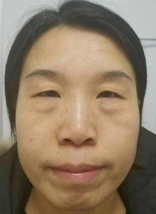眼袋