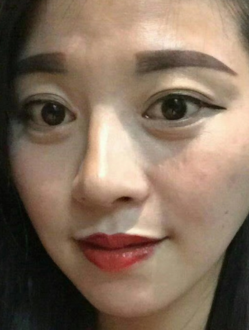 眼袋