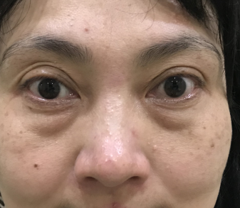 去眼袋手术
