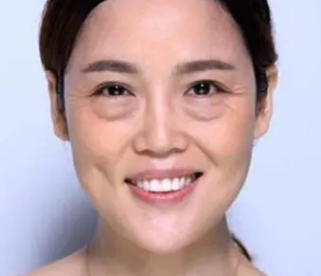 去眼袋手术