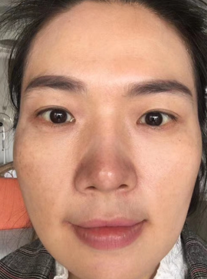 眼袋手术