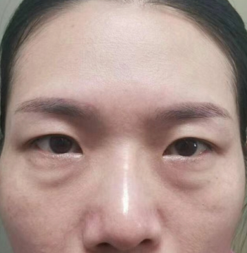 眼袋手术