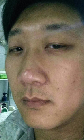去眼袋手术