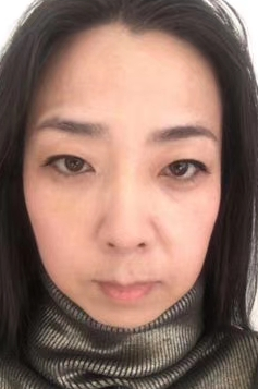 眼袋
