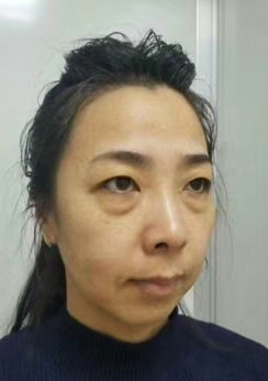 眼袋
