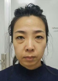 眼袋