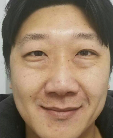 去眼袋手术