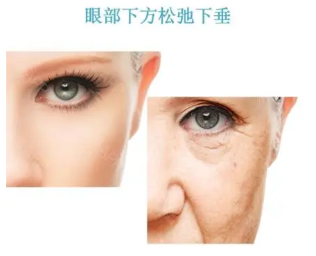 去眼袋手术