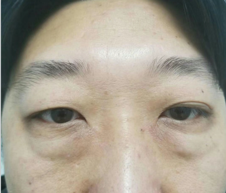 去眼袋手术