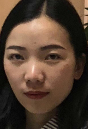 眼袋手术