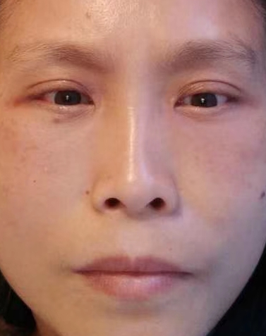 去眼袋手术