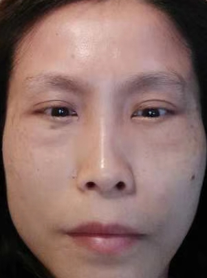 去眼袋手术