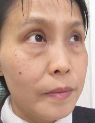 去眼袋手术