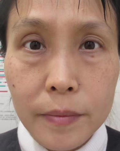 去眼袋手术