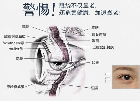 眼袋