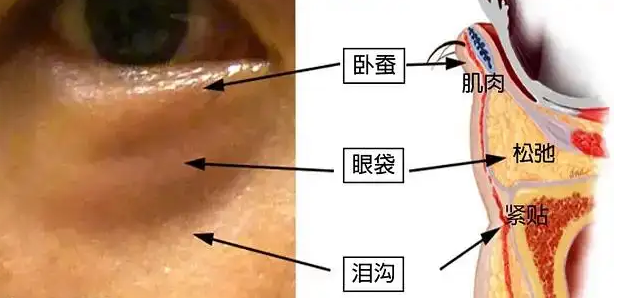 眼袋