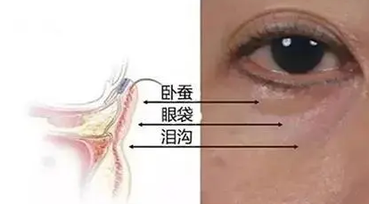 眼袋