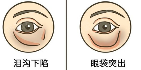 眼袋