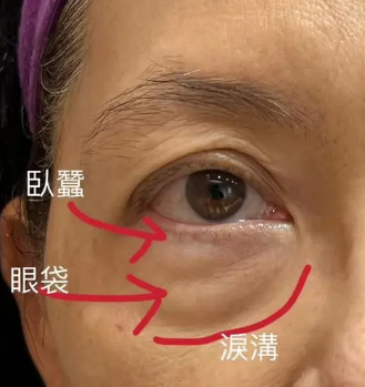 眼袋