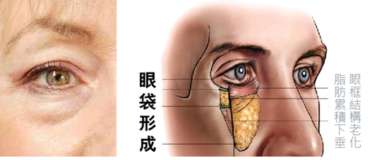 眼袋