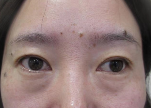 眼袋