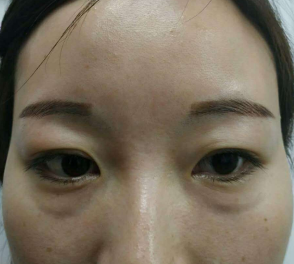 去眼袋手术