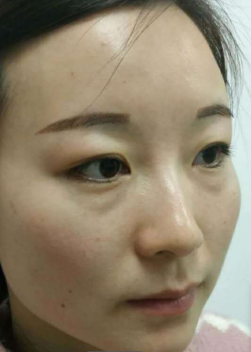 去眼袋手术
