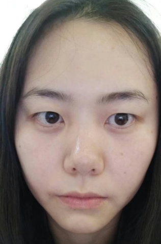 眼袋