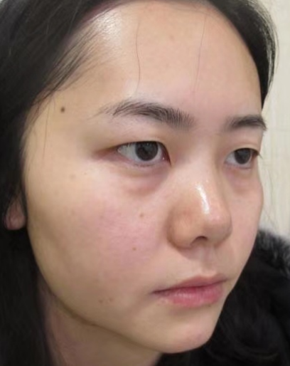 眼袋
