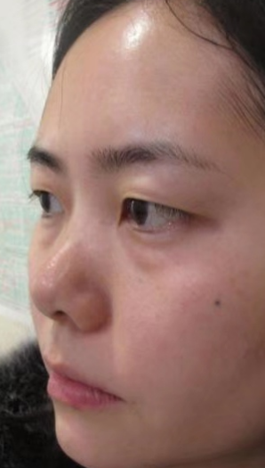眼袋
